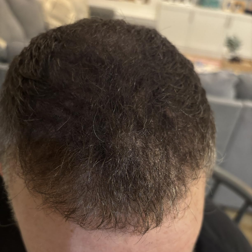 Hairline après