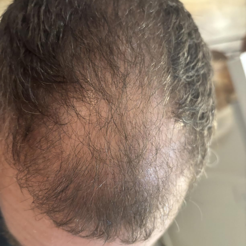 Hairline avant